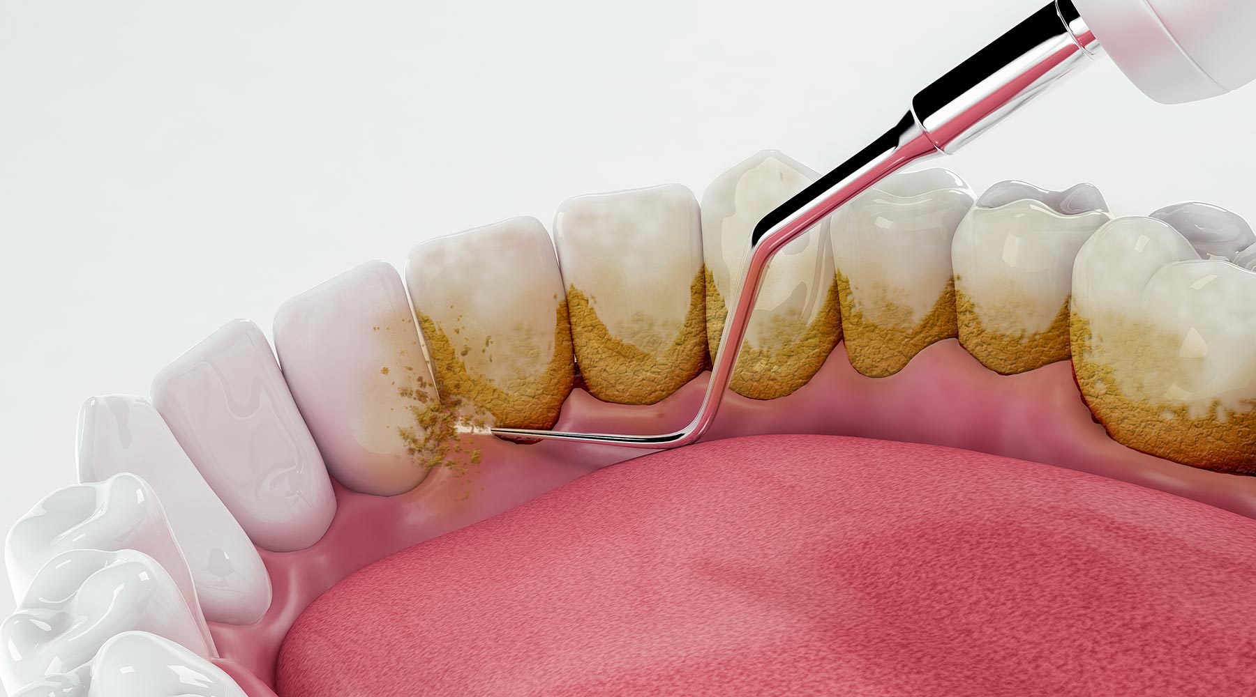 Scaling & Polishing